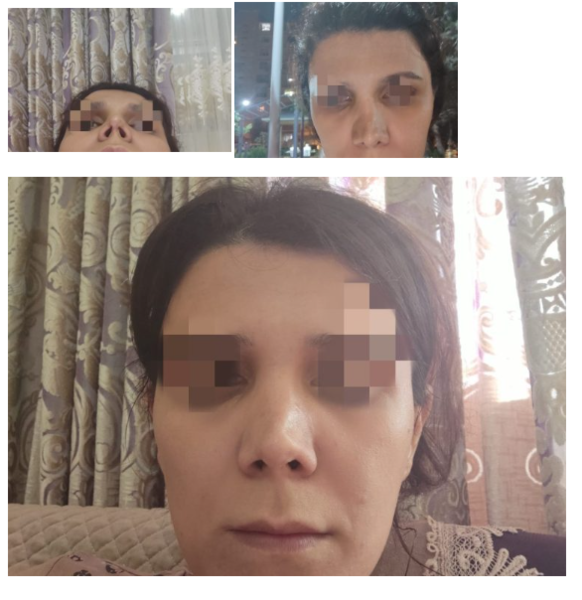 Artromed klinikasında təhlükəli burun əməliyyatı – Vətəndaş prokurorluğa müraciət etdi – VİDEO