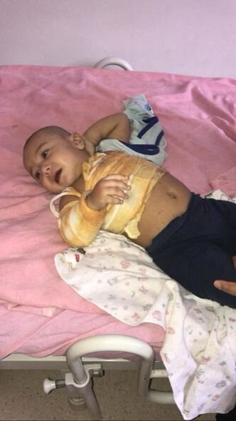 Bədəni yanan Rüqəyyanın anası: "Bir övladımı itirmişəm, ikincini itirməkdən çox qorxuram" - FOTO