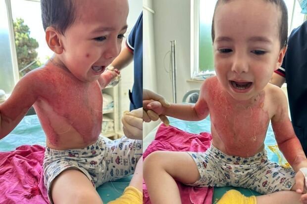 Oyun oynayarkən yanan iki azyaşlı qardaşın köməyinizə ehtiyacları var - FOTO