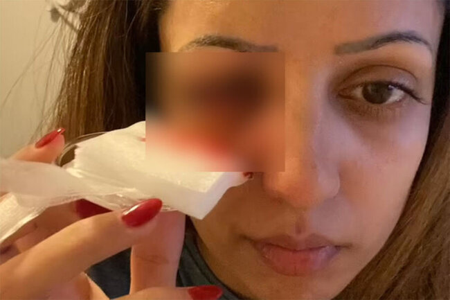 Hovuzda çimib, kor oldu: Həkimə getdikdən sonra hər şey ortaya çıxdı