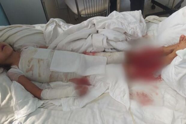 Bütün bədəni yanan yeddi yaşlı Yağmur sizin yardımınıza möhtacdır - FOTO