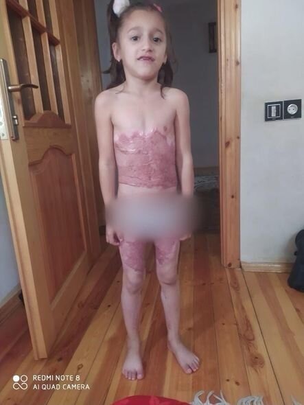 Bədəni yanan Yağmur yardıma möhtacdır: Sizdən kömək gözləyir - FOTO