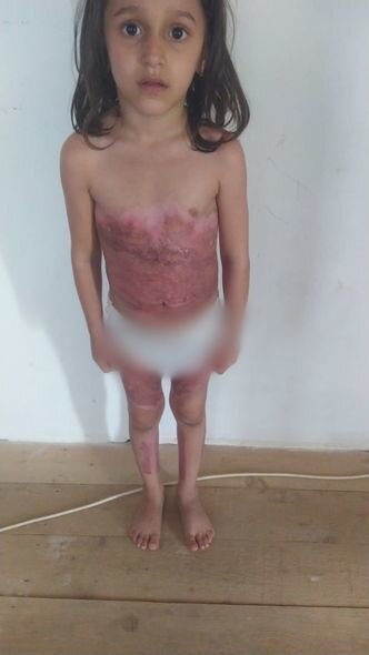 Bədəni yanan Yağmur yardıma möhtacdır: Sizdən kömək gözləyir - FOTO