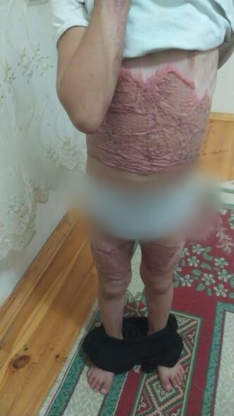 Bədəni yanan Yağmur yardıma möhtacdır: Sizdən kömək gözləyir - FOTO