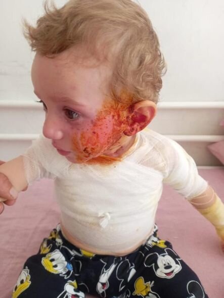 Üzərinə qaynar termos aşırdan Ağamuradın dəstəyə ehtiyacı var - FOTO