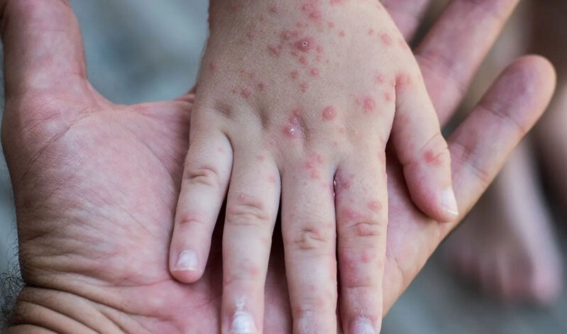 Allergiyalı uşaqlar qızılcaya qarşı peyvənd oluna bilər? - TƏBİB AÇIQLADI