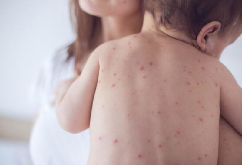 Nazirlikdən qızılca ilə bağlı valideynlərə VACİB ÇAĞIRIŞ