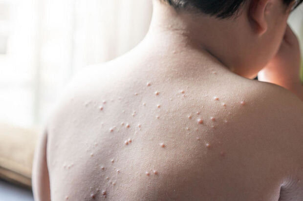 TƏBİB: "Qızılcaya yoluxanları evdə, öz bildikləri kimi müalicə etmək düzgün deyil"