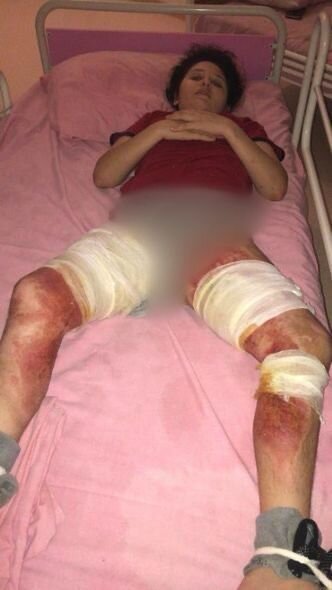 Ağır yanıq xəsarətləri alan qızın yardıma ehtiyacı var: İmkansızlıqdan müalicəsi yarımçıq qalıb - FOTO