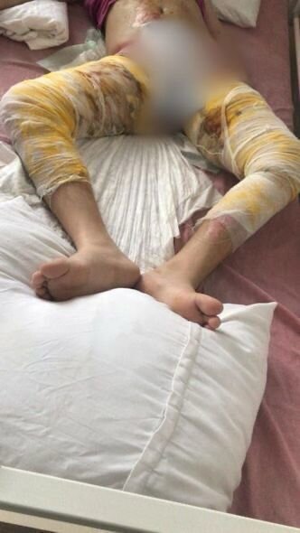 Ağır yanıq xəsarətləri alan qızın yardıma ehtiyacı var: İmkansızlıqdan müalicəsi yarımçıq qalıb - FOTO