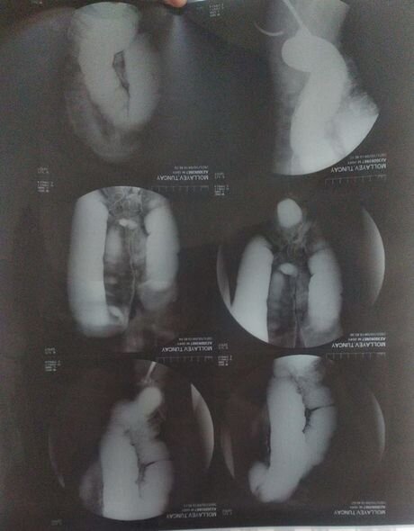 Nadir anadangəlmə anomaliyadan əziyyət çəkən Tuncayın anasından YARDIM ÇAĞIRIŞI - FOTO