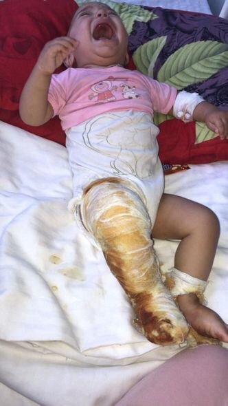 Bədəni yanan körpənin atası fəryad edir: "Dərmanlarını almaq üçün 800 manata ehtiyacımız var" - FOTO