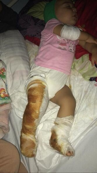 Bədəni yanan körpənin atası fəryad edir: "Dərmanlarını almaq üçün 800 manata ehtiyacımız var" - FOTO