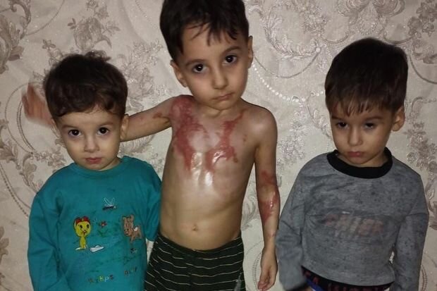 Bədəni yanan azyaşlının atası: "Uşaqlar bayramda Şaxta babanın onlara hədiyyə gətirməsini gözləyirlər" - FOTO