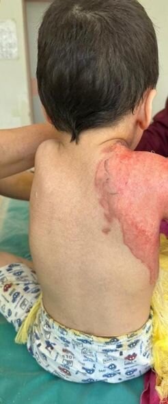 Bədəni yanan azyaşlının atası: "Uşaqlar bayramda Şaxta babanın onlara hədiyyə gətirməsini gözləyirlər" - FOTO