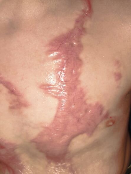 Bədəni yanan azyaşlının atası: "Uşaqlar bayramda Şaxta babanın onlara hədiyyə gətirməsini gözləyirlər" - FOTO