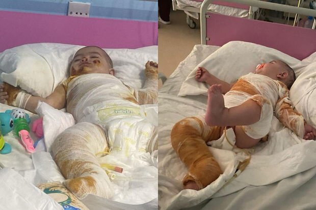 Bütün bədəni yanan körpənin anası fəryad edir: "Ağrılarına görə bütün günü ağlayır" - FOTO