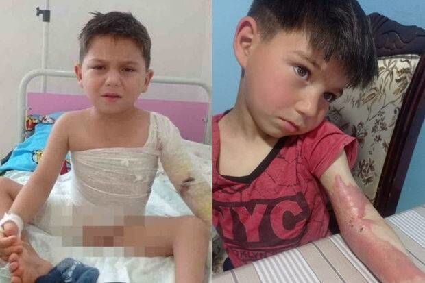 Üzərinə qaynar su tökülən 6 yaşlı Ayxanın anası: "500 manat tapıb dərmanlarını ala bilmirəm" - FOTO/VİDEO