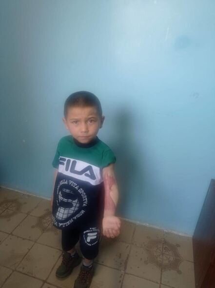 Üzərinə qaynar su tökülən 6 yaşlı Ayxanın anası: "500 manat tapıb dərmanlarını ala bilmirəm" - FOTO/VİDEO