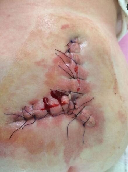 Beş yaşlı qızın sağlam böyrəyinin xilas olunmasına kömək edin - Yardım ÇAĞIRIŞI + FOTO