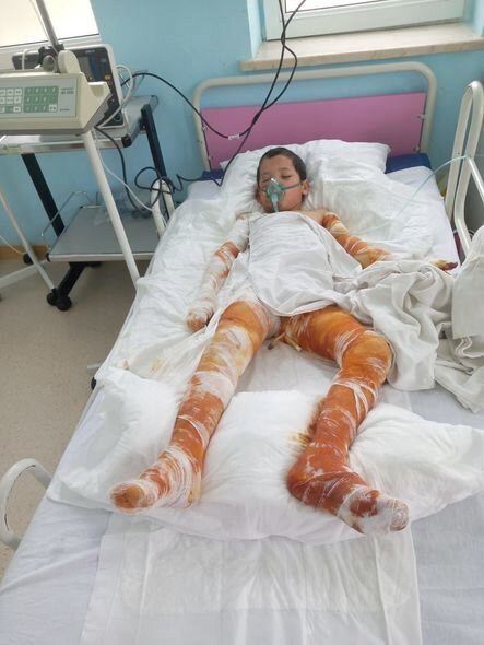 Bədəni yanan Sərxanın anası: "Bəzən yemək almağa belə pul tapmıram" - FOTO