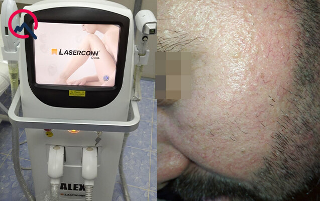 "30 minə aldığım lazer aparatı müştərilərin bədənində qızartı yaradır " - Foto