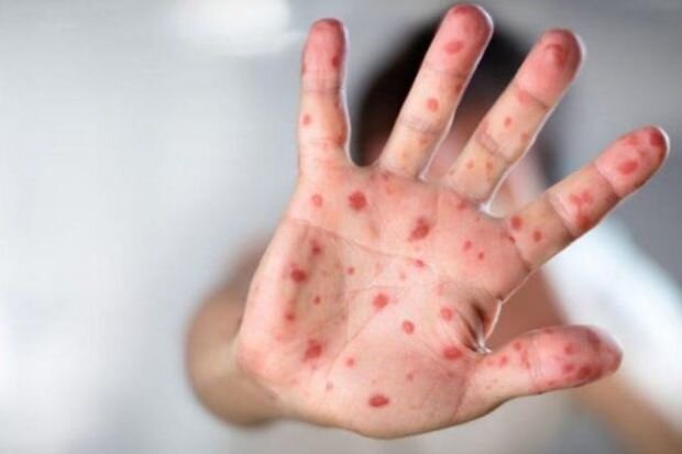 Qızılcaya yoluxanların sayı açıqlandı