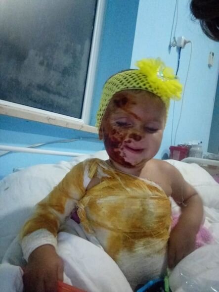 İki yaşlı Zəhranın dəstəyə ehtiyacı var: "Yaralarını sarımağa bint ala bilmirik" - FOTO