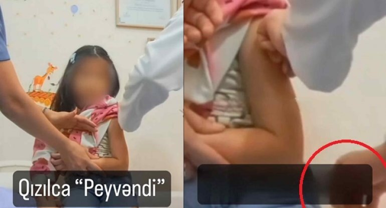 Qızılca peyvəndi VİDEOSU qalmaqal yaratdı: Nə baş verir? - AÇIQLAMA