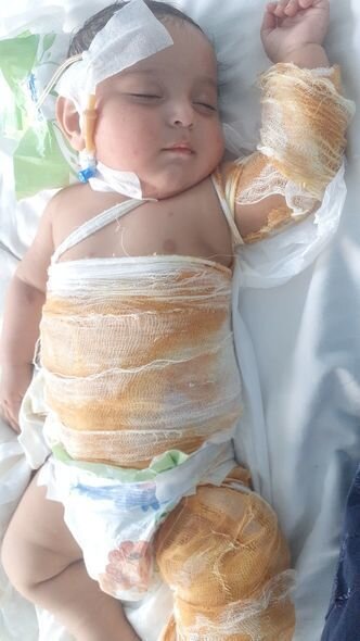 Bir yaşlı körpə qaynar suda yanıb: Müalicə üçün dəstəyə ehtiyacı var - FOTO