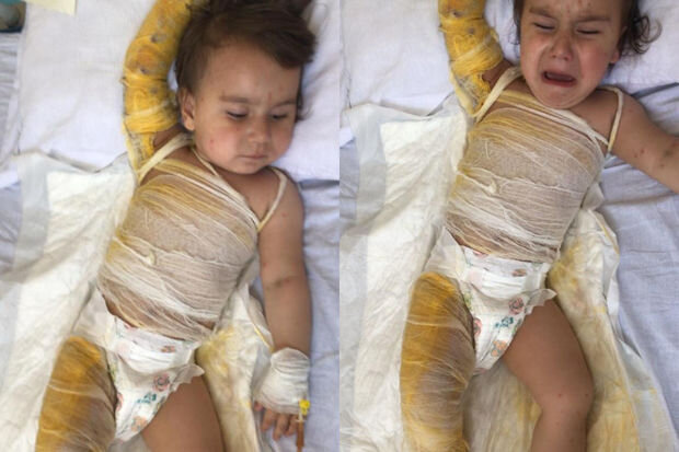 Balaca Zəhranın dəstəyə ehtiyacı var: Müalicəsi yarımçıq qalıb, dərisi çürüyür - FOTO