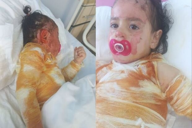 Qaynar suda yanan üç yaşlı Xədicənin sizin köməyinizə ehtiyacı var - FOTO