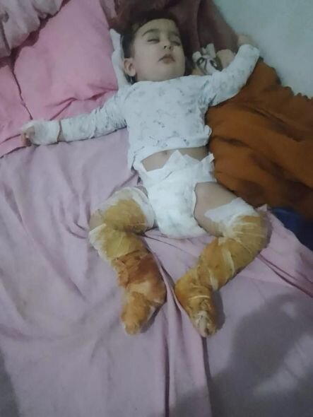 Körpə Muradın dəstəyə ehtiyacı var: Üzərinə qazan aşırdaraq yanıb - FOTO