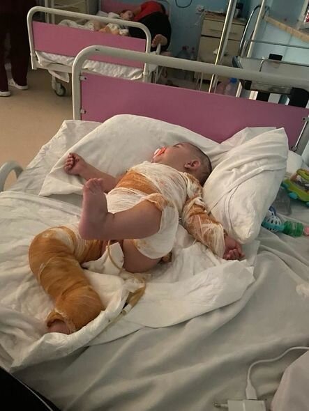 Bütün bədəni yanan körpənin anası fəryad edir: "Ağrılarına görə bütün günü ağlayır" - FOTO