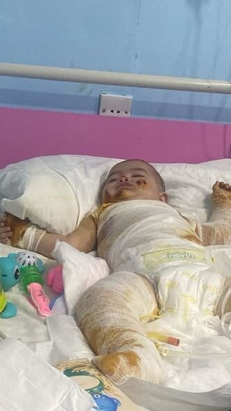 Bütün bədəni yanan körpənin anası fəryad edir: "Ağrılarına görə bütün günü ağlayır" - FOTO