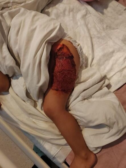 Yanğında xəsarət alan iki yaşlı Zeynəbin sizin köməyinizə ehtiyacı var - FOTO