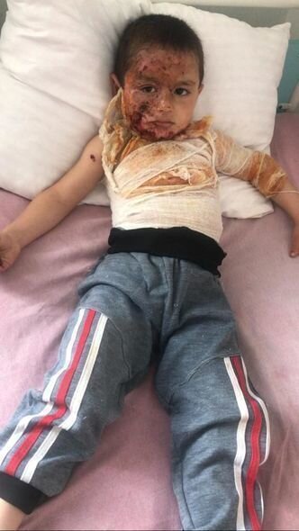 Dörd yaşlı Rəvanın başına qaynar su tökülüb - FOTO