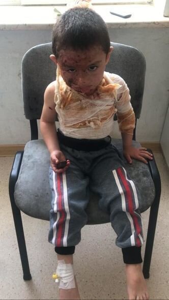 Dörd yaşlı Rəvanın başına qaynar su tökülüb - FOTO