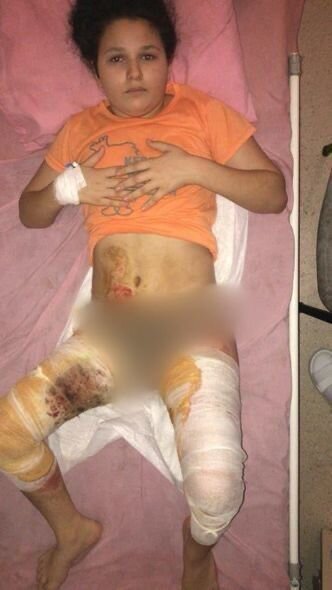 Ağır yanıq xəsarətləri alan qızın yardıma ehtiyacı var: İmkansızlıqdan müalicəsi yarım qalıb - FOTO