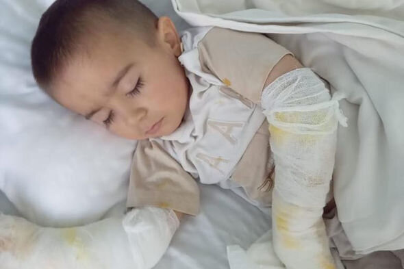 İki yaşlı Asimin əlləri yanıb: Müalicə üçün dəstəyə ehtiyacları var - FOTO