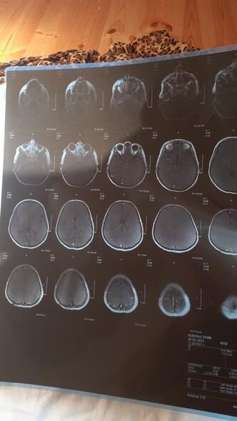 İki ağır xəstəliyi olan Zəhranın anası: "Epilepsiyası tutanda qorxuram geri qaytara bilməyim" - FOTO/VİDEO