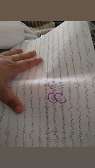 İki yaşlı Raulun anası: "Gün ərzində 3-4 dəfə epilepsiyası tutur" - FOTO