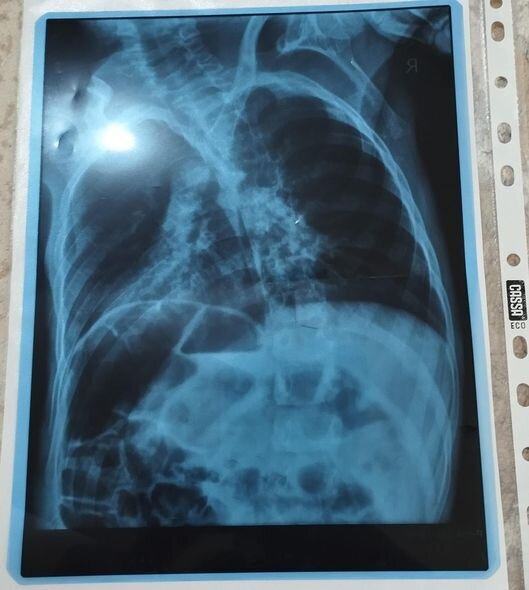 12 yaşlı Ömərin anası yardım diləyir - FOTO