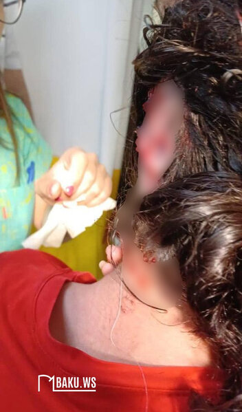 Bakıda it dişləyən azyaşlı qızın SON VƏZİYYƏTİ AÇIQLANIB - FOTO