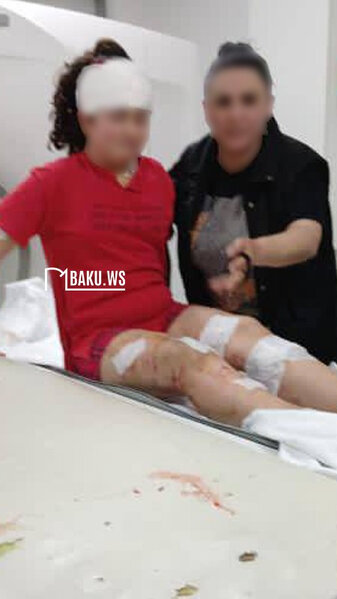 Bakıda it dişləyən azyaşlı qızın SON VƏZİYYƏTİ AÇIQLANIB - FOTO