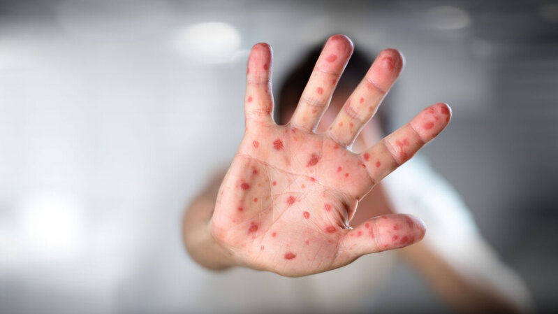 Dünyada sürətlə yayılan meymunçiçəyinə kimlər yoluxa bilər? - Risk qrupları - XƏBƏRDARLIQ