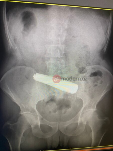 Bakıda bir nəfər 9 ədəd qaşıq uddu (FOTO)