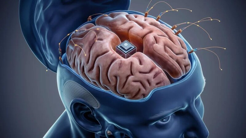 İlon Maskın neyrotexnologiya şirkəti "Neuralink" tərəfindən bu günə qədər cəmi 7 nəfərə beyin çipi yerləşdirildiyi açıqlanıb