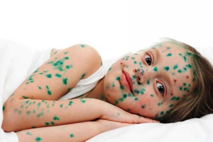 Azərbaycanda suçiçəyinə yoluxma sayı artıb - RƏSMİ