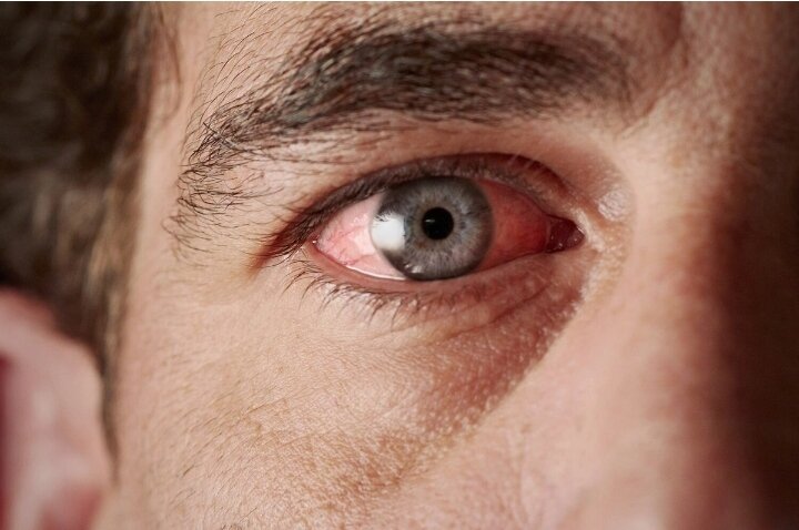 Gözlərdə baş verən bəzi dəyişikliklər bu xəstəliklərin əlaməti ola bilər
